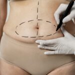 Abdominoplastie : Tout Ce Que Vous Devez Savoir